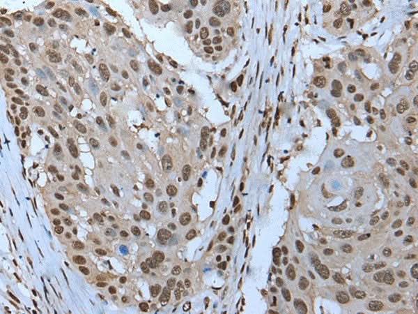 Immunohistochemistry of paraffin-embedded Human esophagus cancer tissue using ZNHIT3 Polyclonal Antibody at dilution of 1:95(×200)