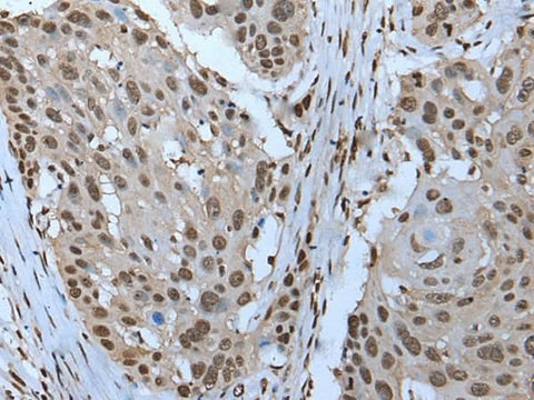 Immunohistochemistry of paraffin-embedded Human esophagus cancer tissue using ZNHIT3 Polyclonal Antibody at dilution of 1:95(×200)