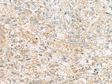 Immunohistochemistry of paraffin-embedded Human liver cancer tissue using EIF4E2 Polyclonal Antibody at dilution of 1:50(×200)