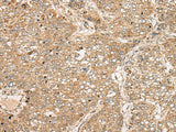 Immunohistochemistry of paraffin-embedded Human liver cancer tissue using TDGF1 Polyclonal Antibody at dilution of 1:50(×200)