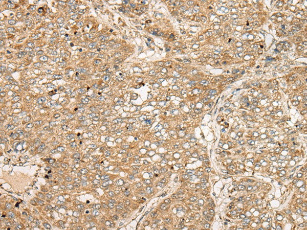 Immunohistochemistry of paraffin-embedded Human liver cancer tissue using TDGF1 Polyclonal Antibody at dilution of 1:50(×200)