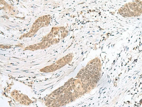 Immunohistochemistry of paraffin-embedded Human esophagus cancer tissue using ENSA Polyclonal Antibody at dilution of 1:40(×200)