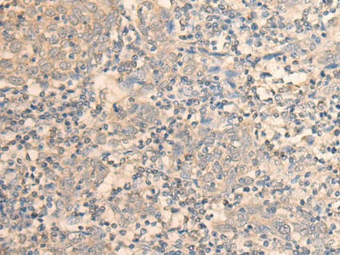 Immunohistochemistry of paraffin-embedded Human cervical cancer tissue using DAZ1 Polyclonal Antibody at dilution of 1:55(×200)