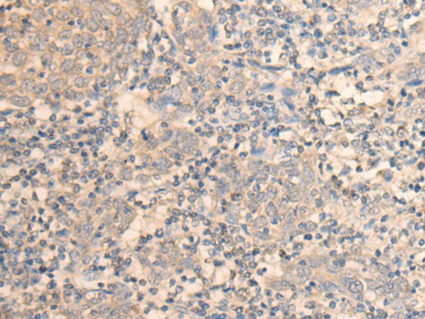 Immunohistochemistry of paraffin-embedded Human cervical cancer tissue using DAZ1 Polyclonal Antibody at dilution of 1:55(×200)