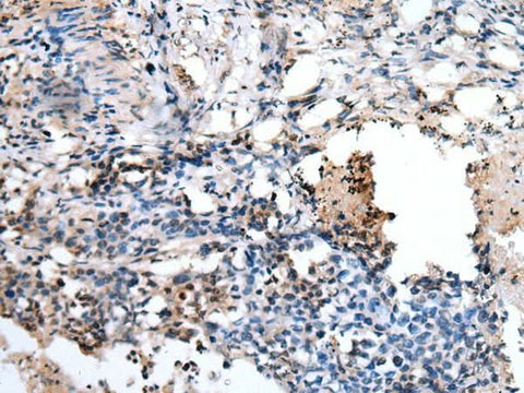 Immunohistochemistry of paraffin-embedded Human lung cancer tissue using PPP1R15A Polyclonal Antibody at dilution of 1:45(×200)