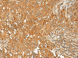 Immunohistochemistry of paraffin-embedded Human cervical cancer tissue using GPR1 Polyclonal Antibody at dilution of 1:50(×200)