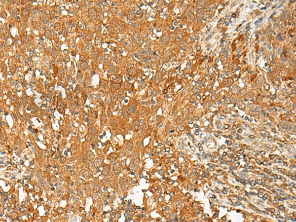 Immunohistochemistry of paraffin-embedded Human cervical cancer tissue using GPR1 Polyclonal Antibody at dilution of 1:50(×200)