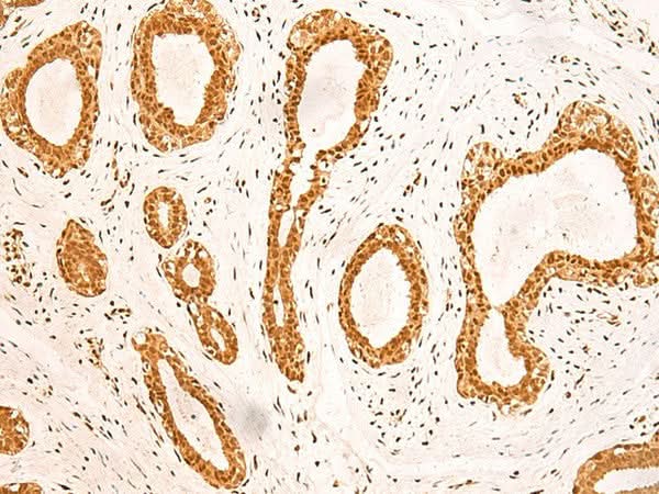 Immunohistochemistry of paraffin-embedded Human breast cancer tissue using ZNF471 Polyclonal Antibody at dilution of 1:50(×200)