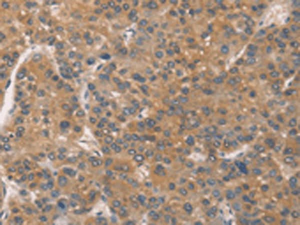 Immunohistochemistry of paraffin-embedded Human liver cancer tissue using ZADH2 Polyclonal Antibody at dilution of 1:51(×200)