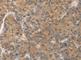 Immunohistochemistry of paraffin-embedded Human liver cancer tissue using ZADH2 Polyclonal Antibody at dilution of 1:51(×200)