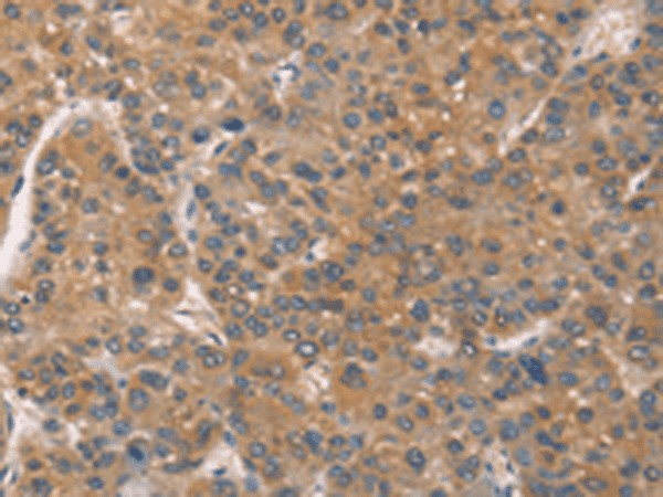 Immunohistochemistry of paraffin-embedded Human liver cancer tissue using ZADH2 Polyclonal Antibody at dilution of 1:51(×200)