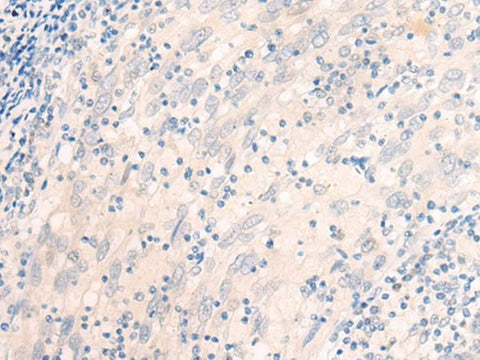 Immunohistochemistry of paraffin-embedded Human cervical cancer tissue using EME2 Polyclonal Antibody at dilution of 1:40(×200)