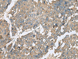 Immunohistochemistry of paraffin-embedded Human liver cancer tissue using PLA2G2A Polyclonal Antibody at dilution of 1:50(×200)