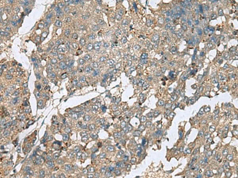 Immunohistochemistry of paraffin-embedded Human liver cancer tissue using PLA2G2A Polyclonal Antibody at dilution of 1:50(×200)