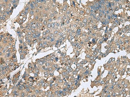 Immunohistochemistry of paraffin-embedded Human liver cancer tissue using PLA2G2A Polyclonal Antibody at dilution of 1:50(×200)