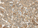 Immunohistochemistry of paraffin-embedded Human liver cancer tissue using ARCN1 Polyclonal Antibody at dilution of 1:50(×200)