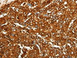 Immunohistochemistry of paraffin-embedded Human liver cancer tissue using PEAR1 Polyclonal Antibody at dilution of 1:25(×200)