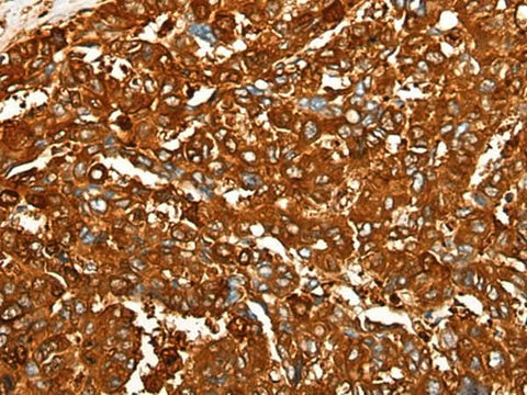 Immunohistochemistry of paraffin-embedded Human liver cancer tissue using PEAR1 Polyclonal Antibody at dilution of 1:25(×200)