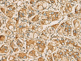 Immunohistochemistry of paraffin-embedded Human liver cancer tissue using AIMP1 Polyclonal Antibody at dilution of 1:55(×200)