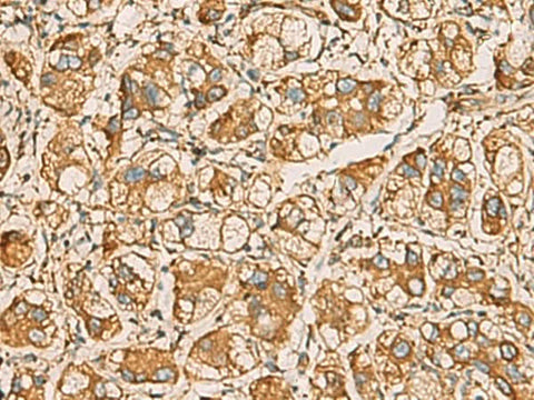 Immunohistochemistry of paraffin-embedded Human liver cancer tissue using AIMP1 Polyclonal Antibody at dilution of 1:55(×200)