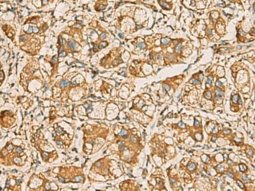 Immunohistochemistry of paraffin-embedded Human liver cancer tissue using AIMP1 Polyclonal Antibody at dilution of 1:55(×200)