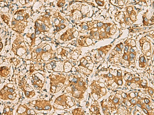 Immunohistochemistry of paraffin-embedded Human liver cancer tissue using AIMP1 Polyclonal Antibody at dilution of 1:55(×200)