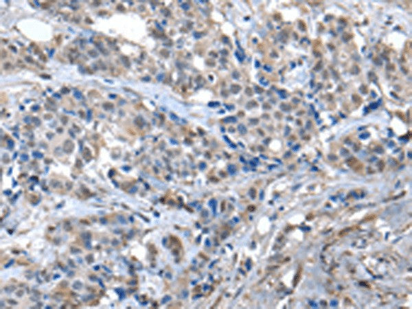 Immunohistochemistry of paraffin-embedded Human breast cancer tissue using ZFP2 Polyclonal Antibody at dilution of 1:40(×200)