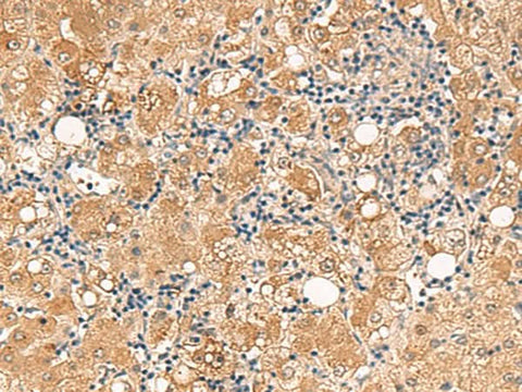 Immunohistochemistry of paraffin-embedded Human liver cancer tissue using FUNDC2 Polyclonal Antibody at dilution of 1:60(×200)