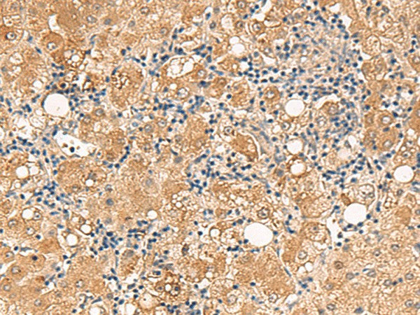 Immunohistochemistry of paraffin-embedded Human liver cancer tissue using FUNDC2 Polyclonal Antibody at dilution of 1:60(×200)