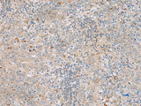 Immunohistochemistry of paraffin-embedded Human cervical cancer tissue using SAXO2 Polyclonal Antibody at dilution of 1:45(×200)