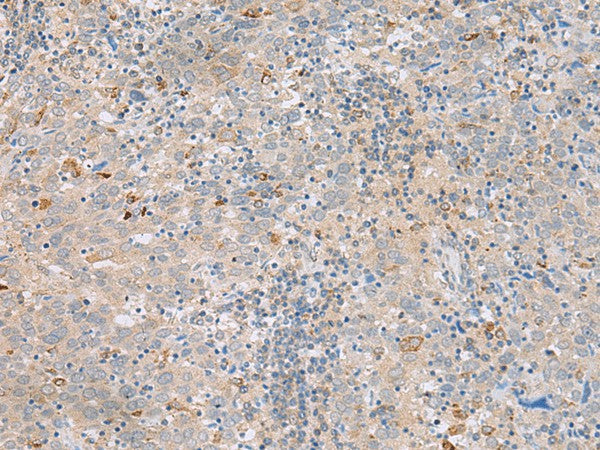 Immunohistochemistry of paraffin-embedded Human cervical cancer tissue using SAXO2 Polyclonal Antibody at dilution of 1:45(×200)