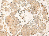Immunohistochemistry of paraffin-embedded Human lung cancer tissue using TEX11 Polyclonal Antibody at dilution of 1:30(×200)
