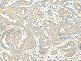 Immunohistochemistry of paraffin-embedded Human liver cancer tissue using HLA-DRB5 Polyclonal Antibody at dilution of 1:45(×200)