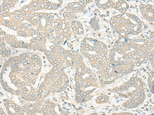 Immunohistochemistry of paraffin-embedded Human liver cancer tissue using HLA-DRB5 Polyclonal Antibody at dilution of 1:45(×200)
