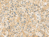 Immunohistochemistry of paraffin-embedded Human liver cancer tissue using NANP Polyclonal Antibody at dilution of 1:65(×200)