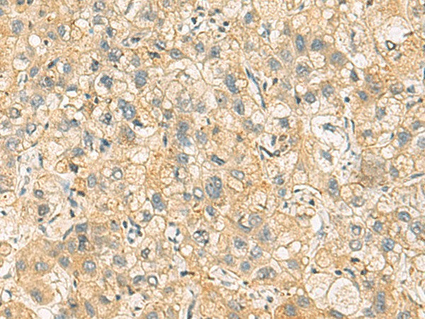 Immunohistochemistry of paraffin-embedded Human liver cancer tissue using NANP Polyclonal Antibody at dilution of 1:65(×200)