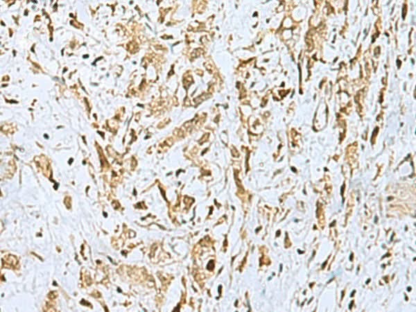 Immunohistochemistry of paraffin-embedded Human gastric cancer tissue using HOXC9 Polyclonal Antibody at dilution of 1:110(×200)