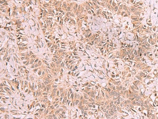 Immunohistochemistry of paraffin-embedded Human ovarian cancer tissue using RRP8 Polyclonal Antibody at dilution of 1:70(×200)