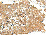 Immunohistochemistry of paraffin-embedded Human lung cancer tissue using PRLHR Polyclonal Antibody at dilution of 1:70(×200)