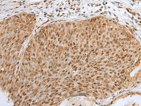 Immunohistochemistry of paraffin-embedded Human cervical cancer tissue using ZNF354A Polyclonal Antibody at dilution of 1:40(×200)