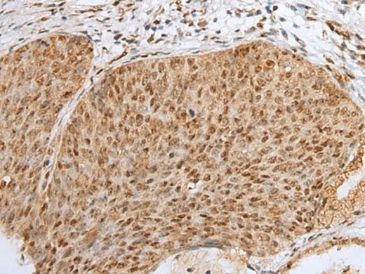 Immunohistochemistry of paraffin-embedded Human cervical cancer tissue using ZNF354A Polyclonal Antibody at dilution of 1:40(×200)