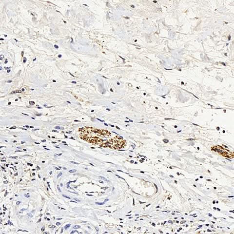 mmunohistochemistry analysis of paraffin-embedded human stomach cancer using ENO2 Polyclonal Antibody at dilution of 1:300.