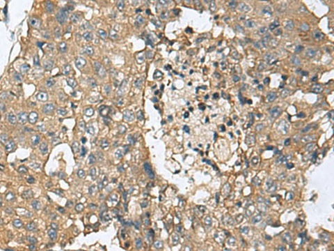 Immunohistochemistry of paraffin-embedded Human liver cancer tissue using CD59 Polyclonal Antibody at dilution of 1:160(×200)