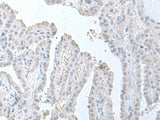 Immunohistochemistry of paraffin-embedded Human thyroid cancer tissue using STAU2 Polyclonal Antibody at dilution of 1:60(×200)