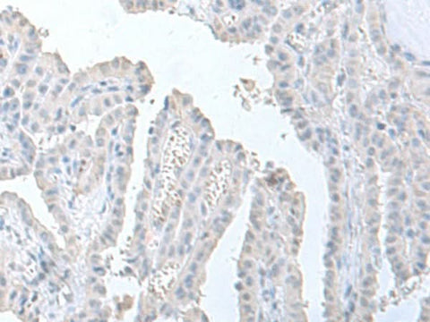 Immunohistochemistry of paraffin-embedded Human thyroid cancer tissue using STAU2 Polyclonal Antibody at dilution of 1:60(×200)