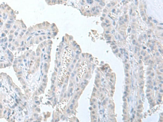 Immunohistochemistry of paraffin-embedded Human thyroid cancer tissue using STAU2 Polyclonal Antibody at dilution of 1:60(×200)