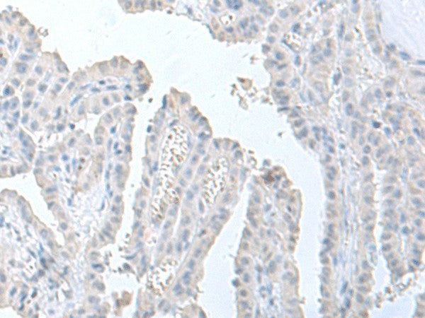 Immunohistochemistry of paraffin-embedded Human thyroid cancer tissue using STAU2 Polyclonal Antibody at dilution of 1:60(×200)