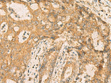 Immunohistochemistry of paraffin-embedded Human cervical cancer tissue using CNST Polyclonal Antibody at dilution of 1:70(×200)