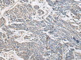 Immunohistochemistry of paraffin-embedded Human colorectal cancer tissue using PRKCSH Polyclonal Antibody at dilution of 1:65(×200)