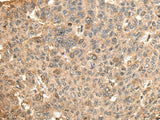 Immunohistochemistry of paraffin-embedded Human liver cancer tissue using HMMR Polyclonal Antibody at dilution of 1:45(×200)